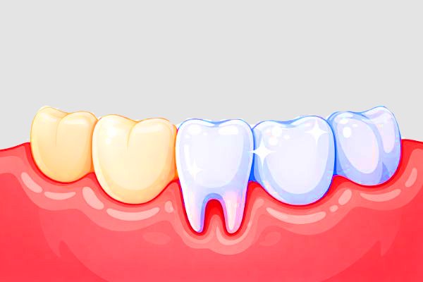 How to Whiten Teeth Safely: At Home vs. Professional Whitening
